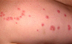 What Do Bed Bug Bites Look Like?